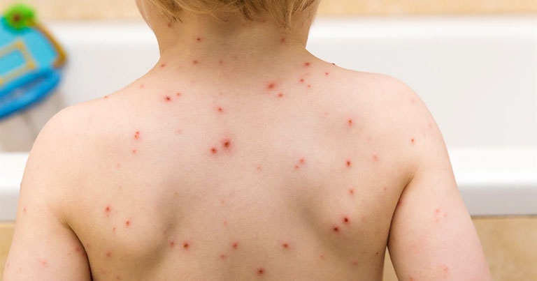 fish allergy symptoms.